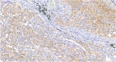 PD-1 and PD-L1 expression in rare lung tumors